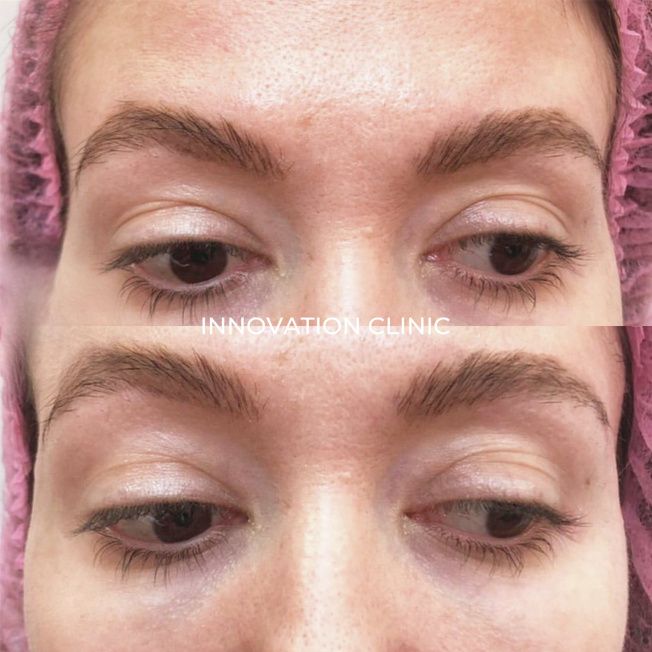 Коррекция формы висков фото до и после