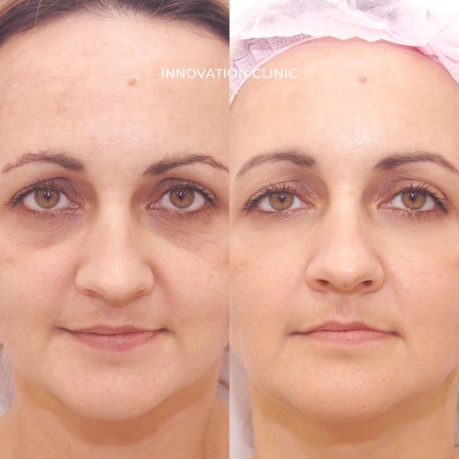 Лечение гиперпигментации кожи фото до и после 1