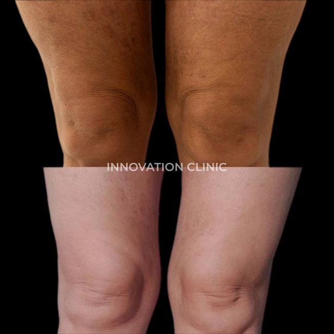 Малоинвазивный RF-лифтинг фото до и после 2