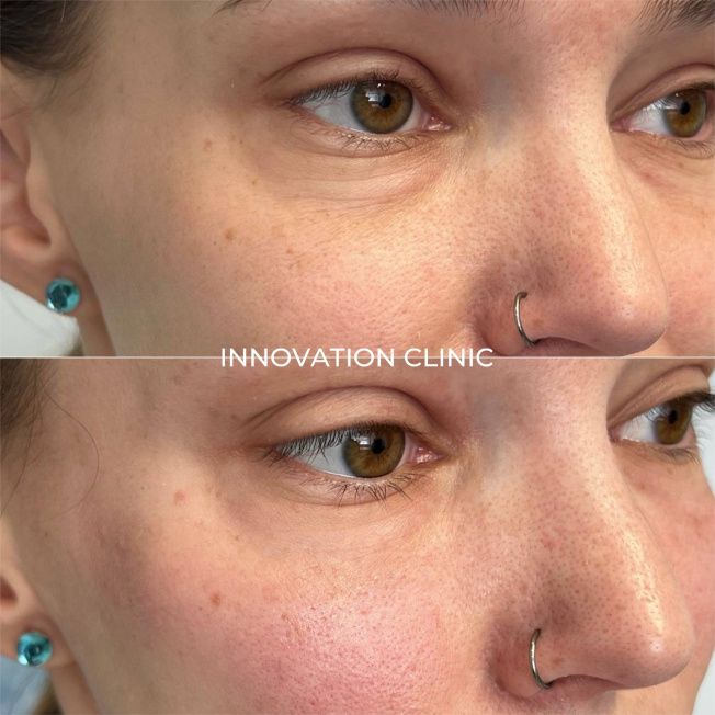 Коррекция носослёзной борозды фото до и после 15