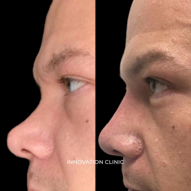 Коррекция спинки носа филлером фото до и после 4