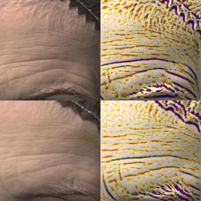 Биореструктуризация препаратом ARES Anti-Age фото до и после 2