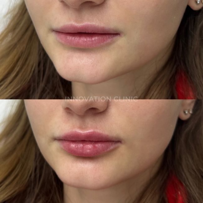 Коррекция формы губ филлером фото до и после 16