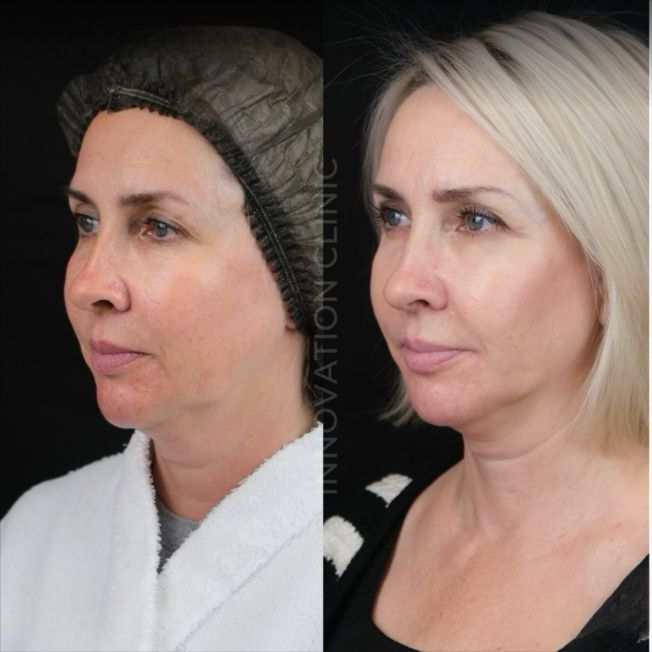 Монополярный RF-лифтинг Volnewmer фото до и после 5