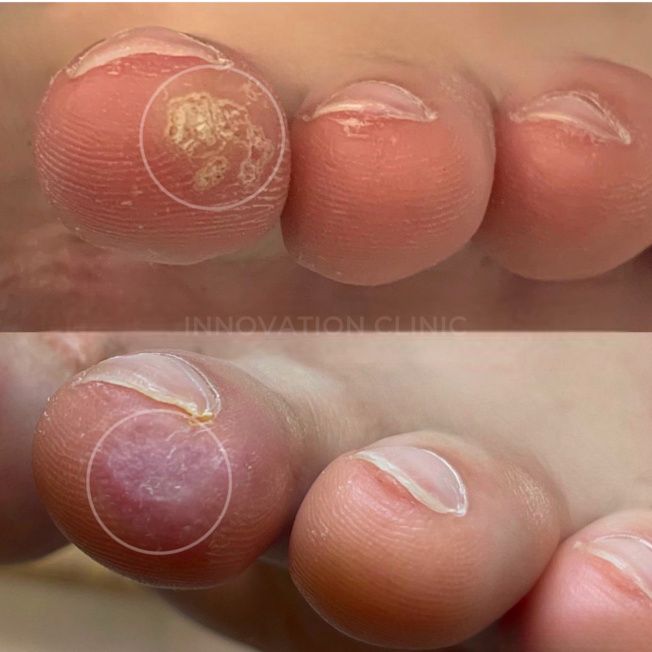 Удаление бородавок фото до и после