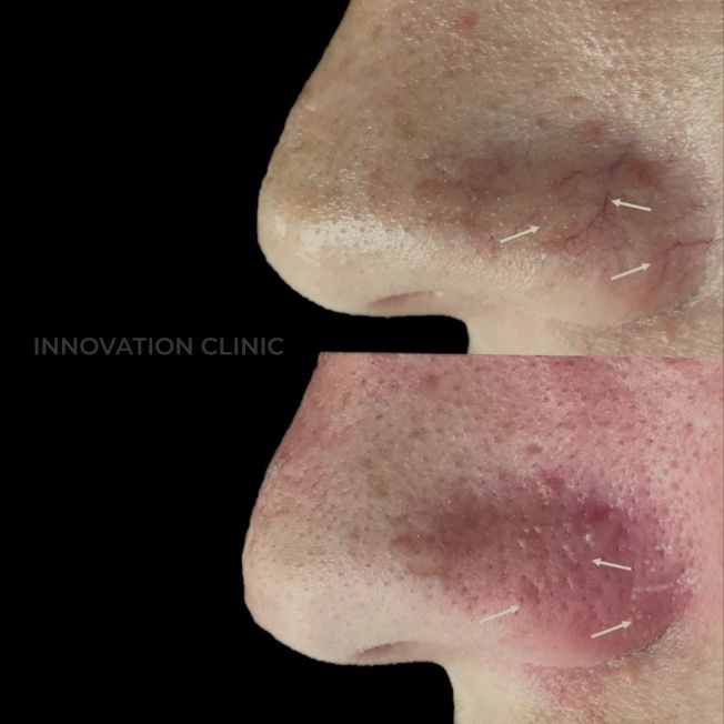 Устранение сосудистых патологий кожи фото до и после 2