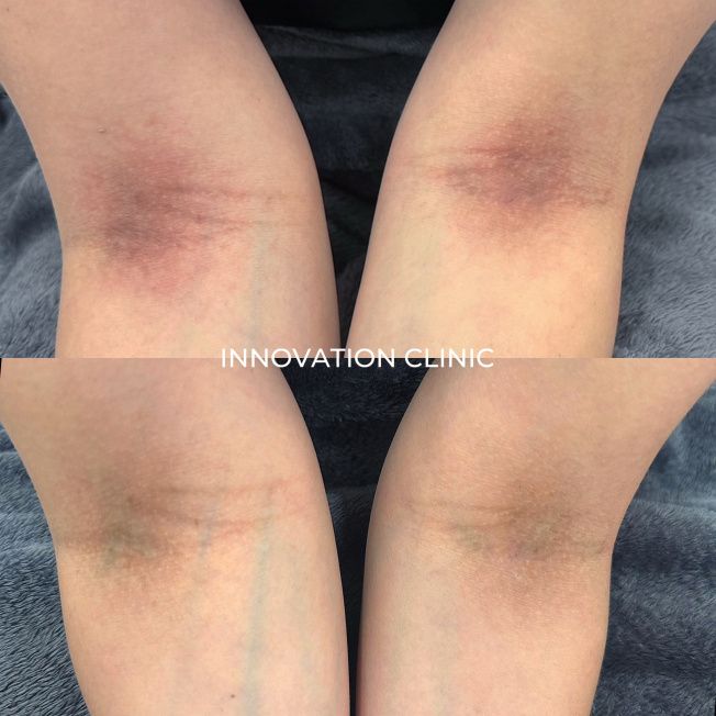 Лечение пигментации фото до и после