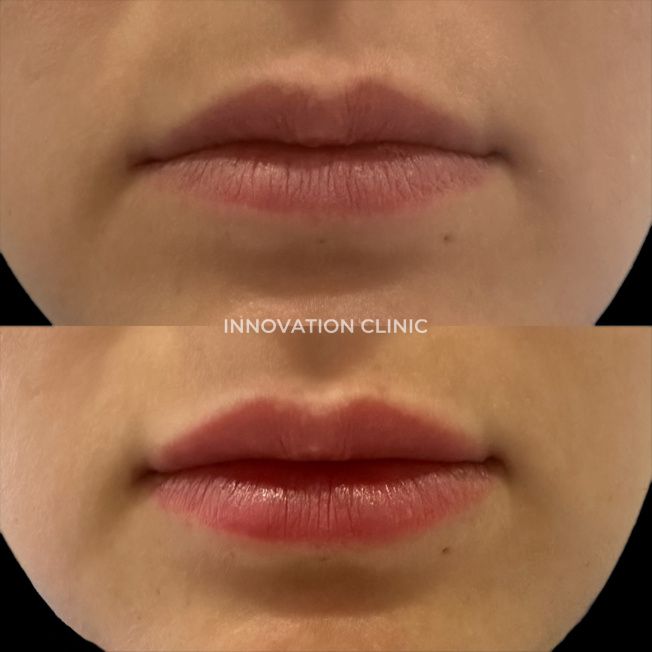 Коррекция формы губ филлером фото до и после 21