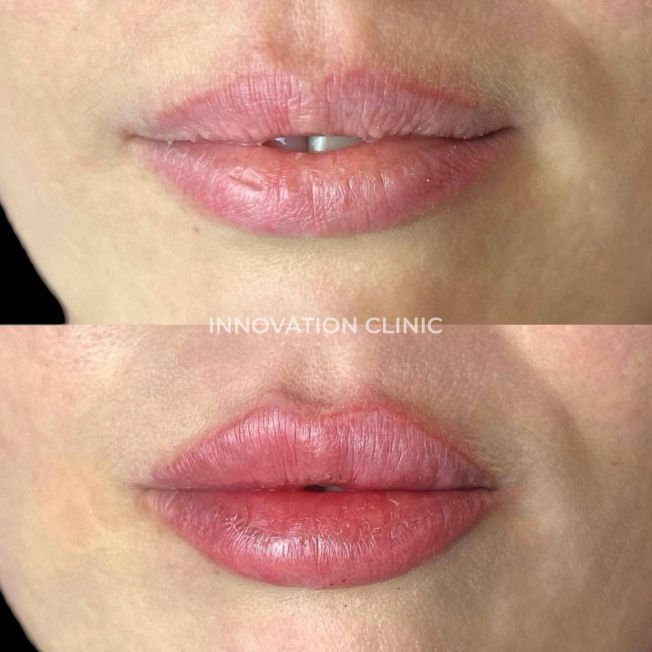 Коррекция формы губ филлером фото до и после 4