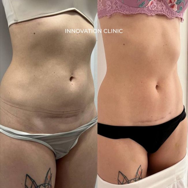 Микроигольчатый РФ-лифтинг живота Morpheus 8