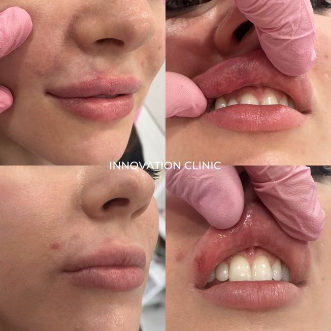 Лечение сосудистой эмболии фото до и после 2