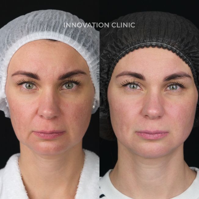 Монополярный RF-лифтинг Volnewmer фото до и после 2