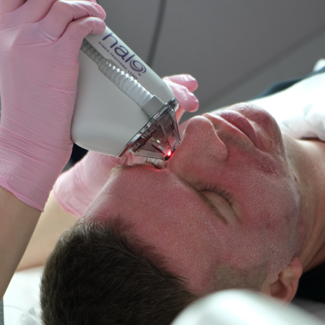 Фракционный лазер для лица