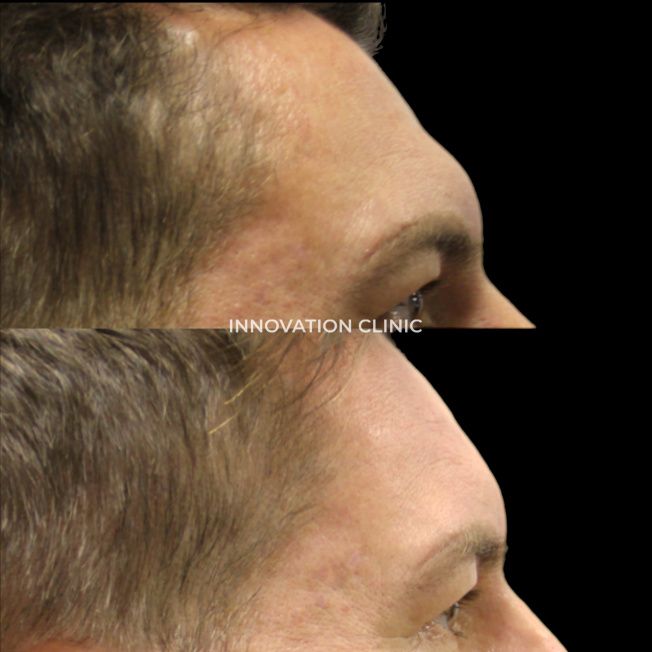 Коррекция формы лба филлером фото до и после