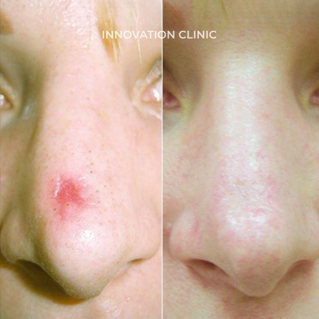 Лечение рубцовой деформации тканей носа фото до и после