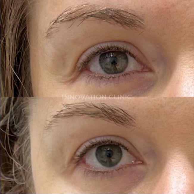 УЗ SMAS-лифтинг верхнего века фото до и после