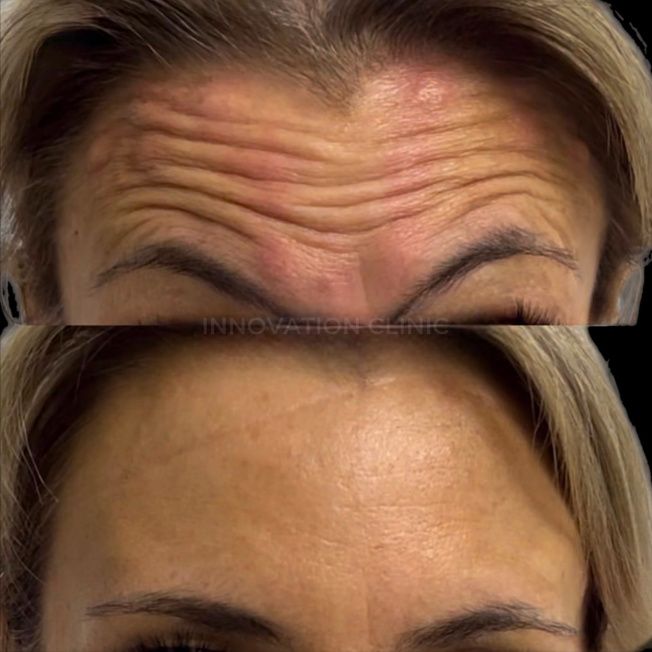 Коррекция мимических морщин лба фото до и после 1