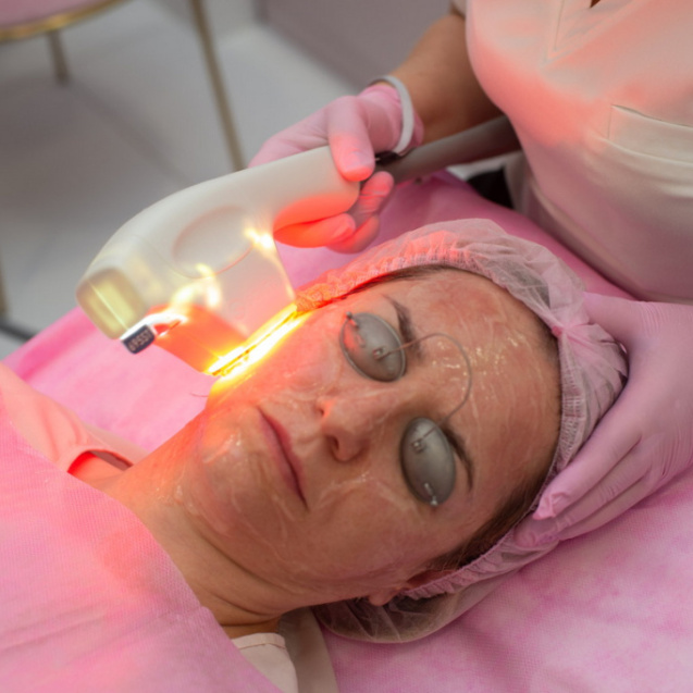 Фотоомоложение лица