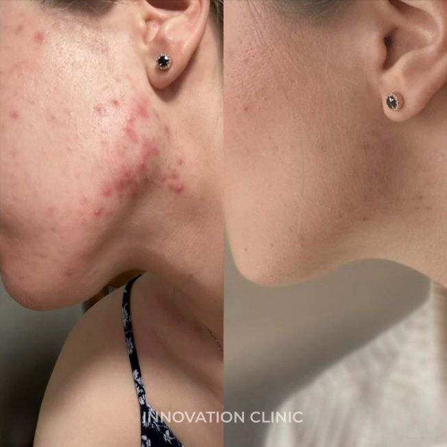 Комплексное лечение акне фото до и после 10