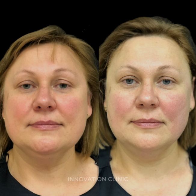 УЗ SMAS-лифтинг нижней трети лица фото до и после 5