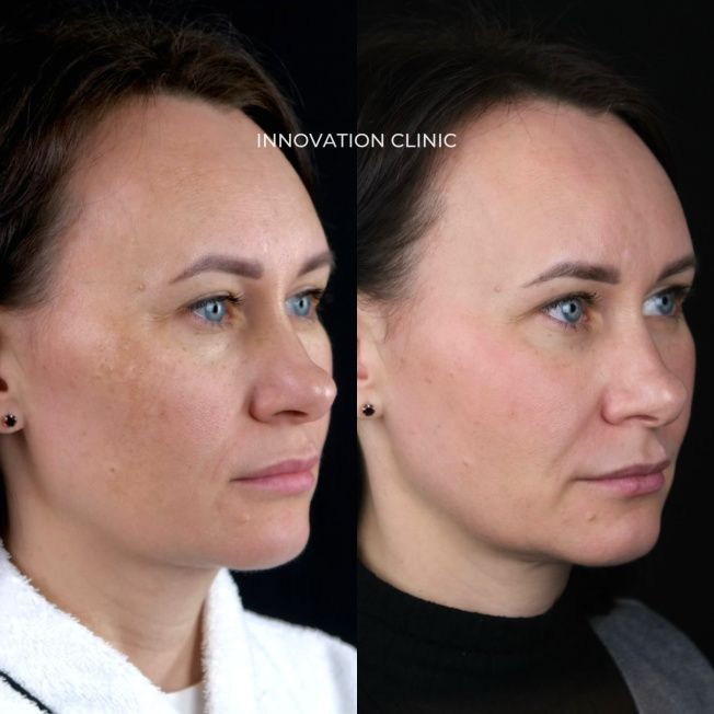 Протокол лечения пигментации фото до и после 