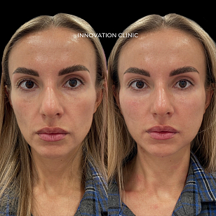 Фуллфейс-коррекция лица филлерами