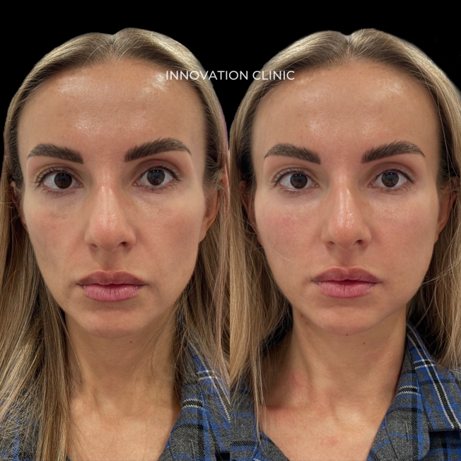 Фуллфейс-коррекция лица филлерами