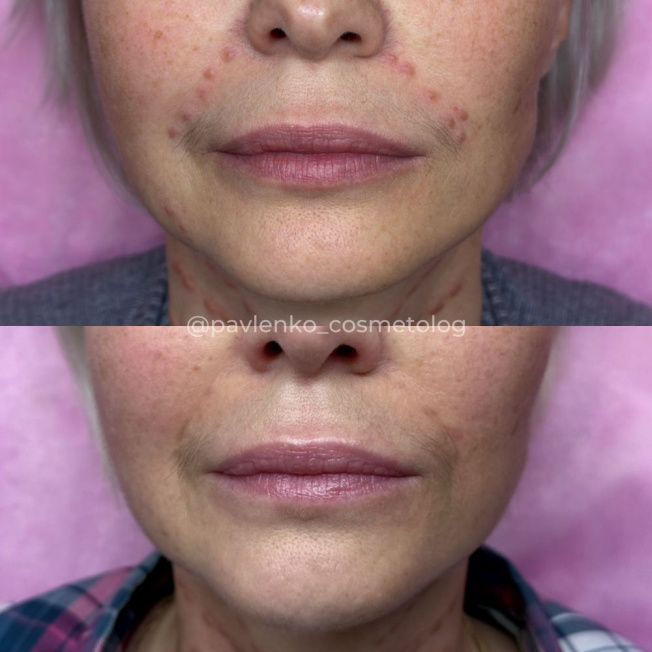 Лечение гранулемы инородного тела