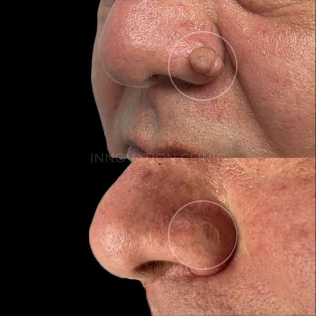 Удаление доброкачественного новообразования фото до и после 4