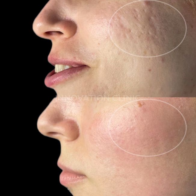 Лазерная шлифовка лица фото до и после 1