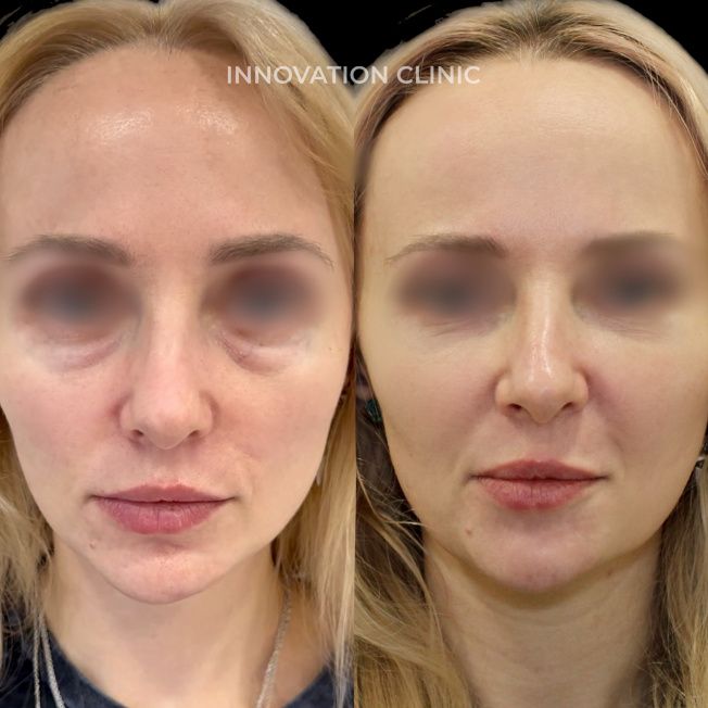 Коррекция носослёзной борозды фото до и после 6