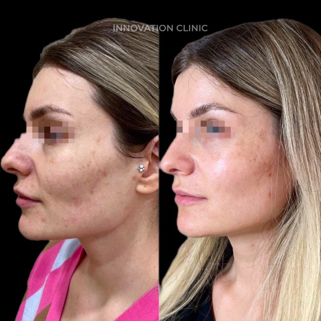 УЗ SMAS-лифтинг нижней трети лица фото до и после 10