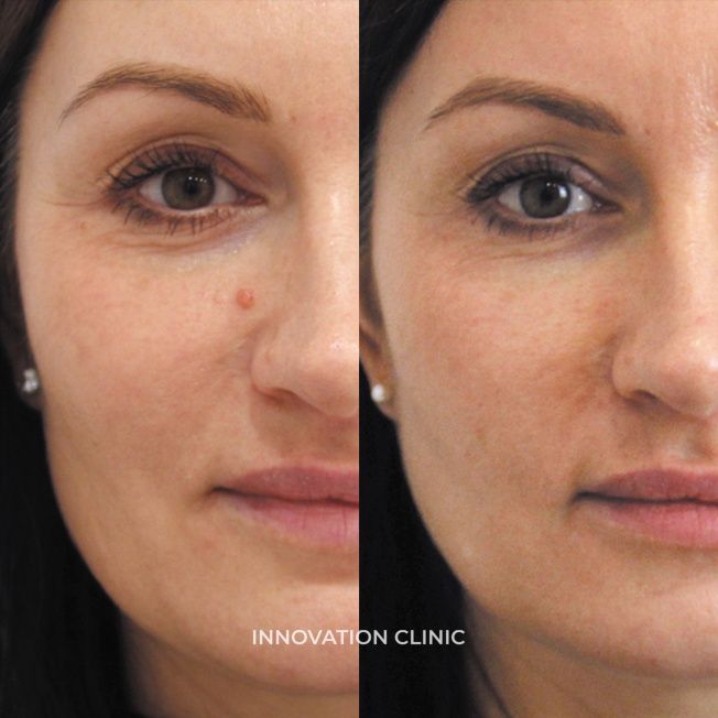 Удаление новообразований фото до и после