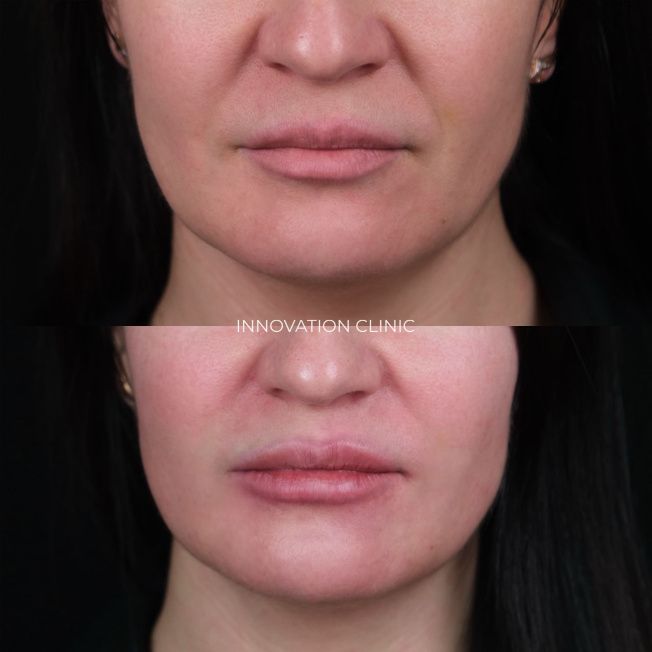 Нитевой лифтинг губ