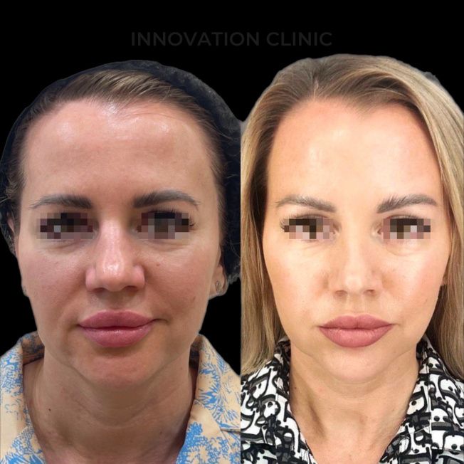 УЗ SMAS-лифтинг нижней трети лица фото до и после 6