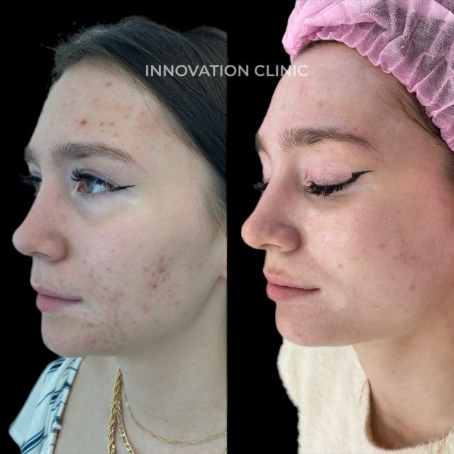 Комплексное лечение акне фото до и после 8