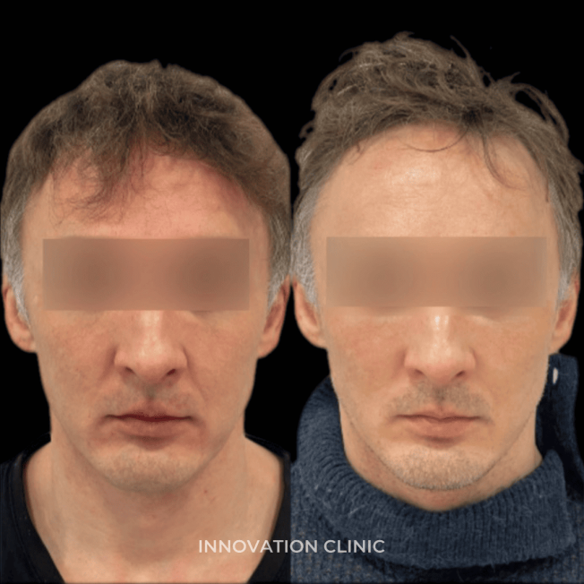 Нитевой лифтинг лица фото до и после 11