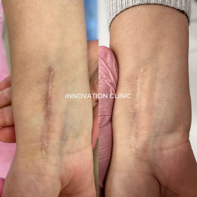 Лечение гипертрофических посттравматических рубцов фото до и после