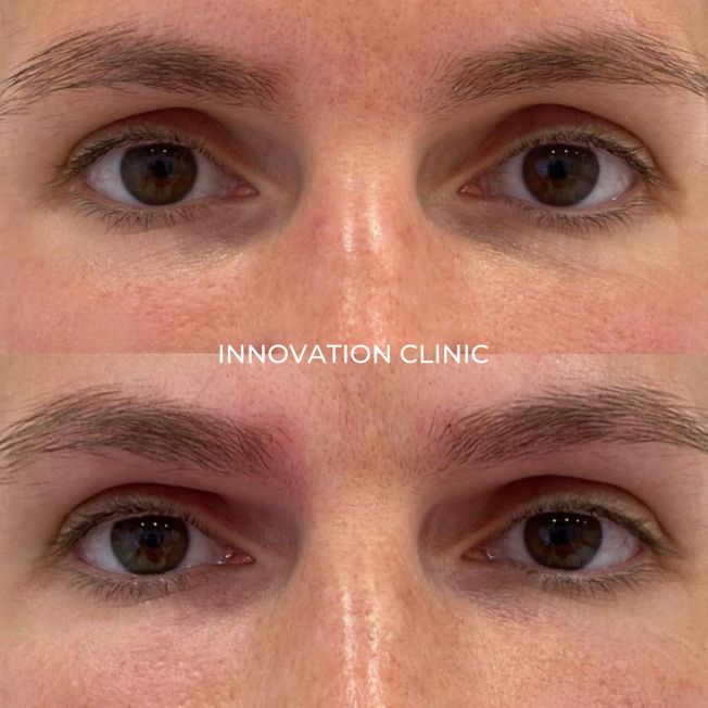 Коррекция формы верхнего века фото до и после 3