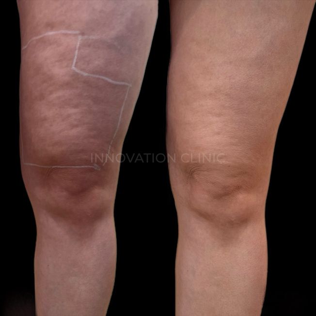 УЗ SMAS-лифтинг передней поверхности бедра фото до и после