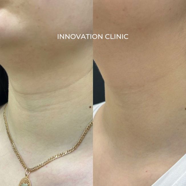 Коррекция "колец Венеры" фото до и после 2