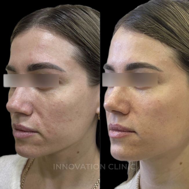 УЗ SMAS-лифтинг нижней трети лица фото до и после 9