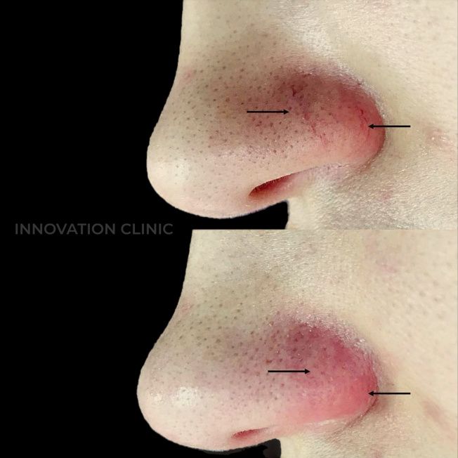 Устранение сосудистых патологий кожи фото до и после 3