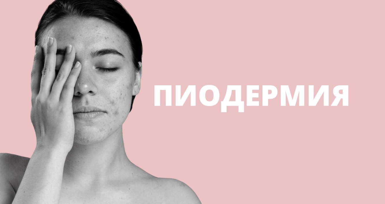 Пиодермия