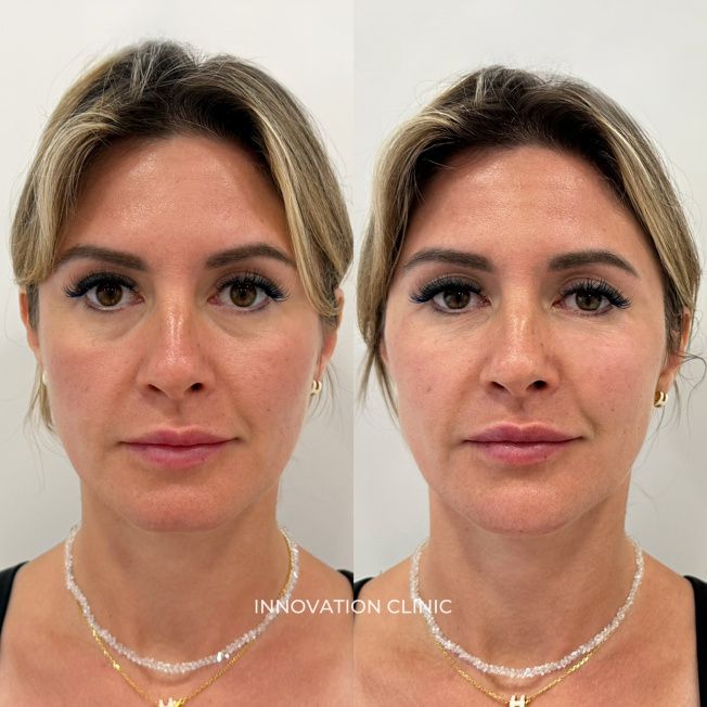 Деликатная FullFace-коррекция лица фото до и после 1