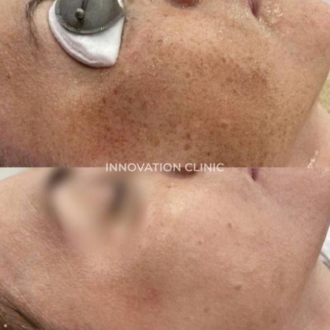 Сочетанный протокол фототерапия BBL фото до и после 2