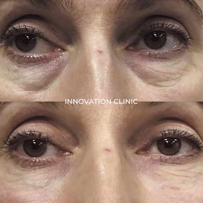 Коррекция носослёзной борозды фото до и после 3