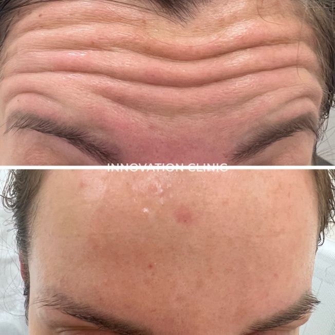 Коррекция мимических морщин лба фото до и после 5