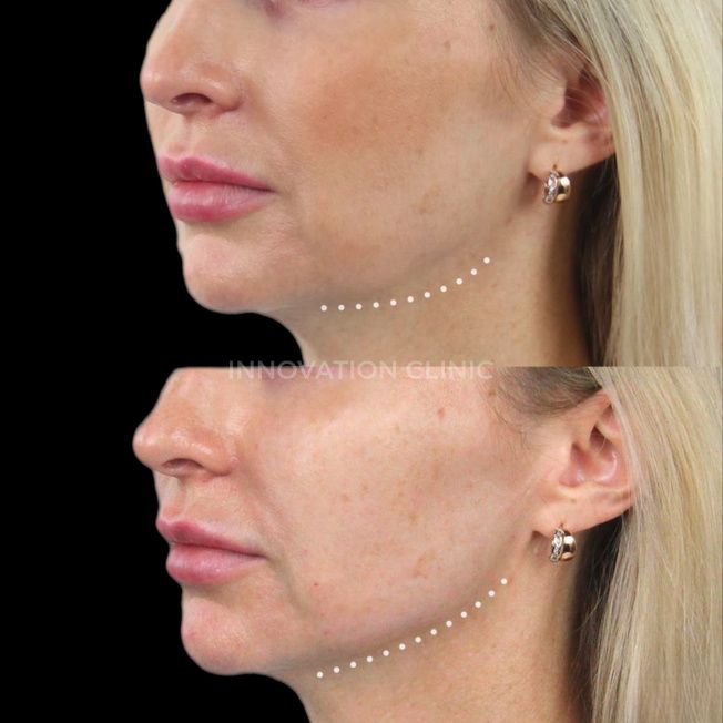 Нитевой лифтинг лица фото до и после 4