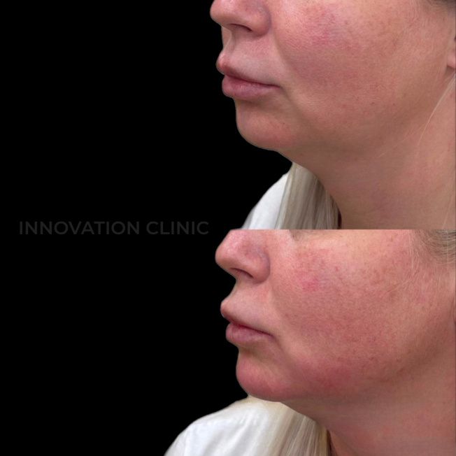 Коррекция нижней трети лица фото до и после 2